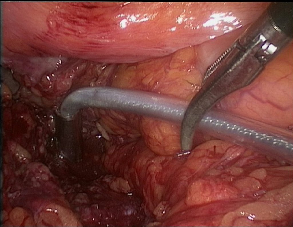 Figura 112: descrição da cirurgia vídeo Laparoscópica.