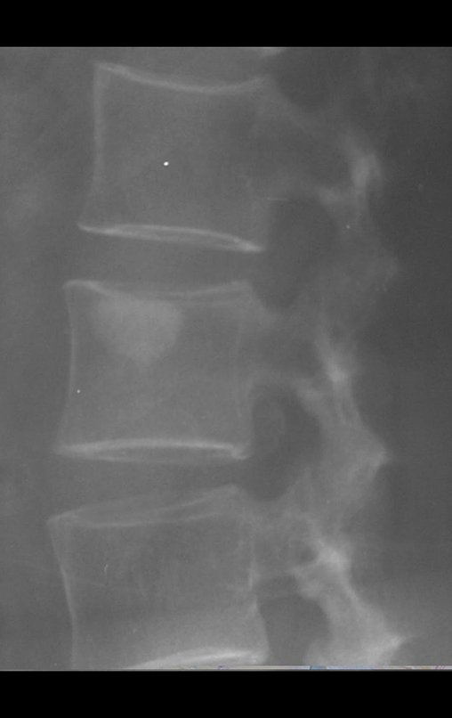 Figura 14 : Osteoma medular do corpo vertebral, enostose óssea.