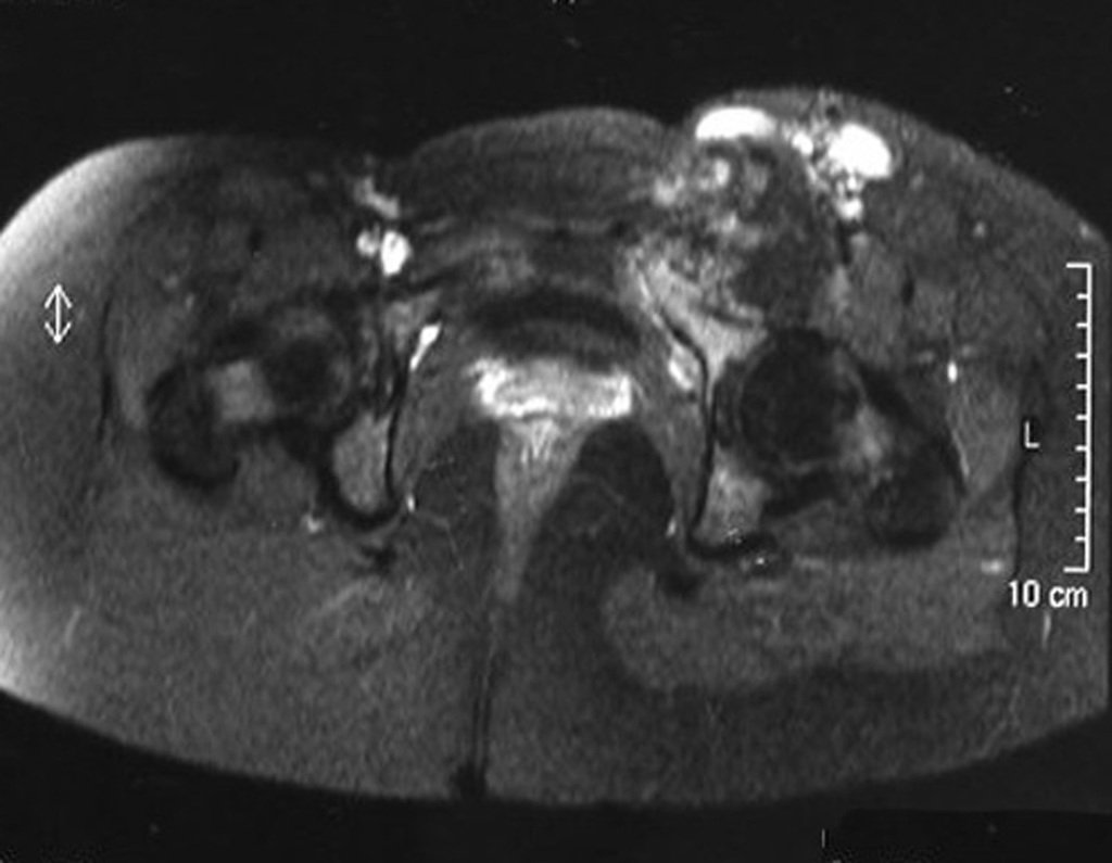 Figura 73: Em T1, com supressão e contraste, verificamos a captação em um tumor sólido.