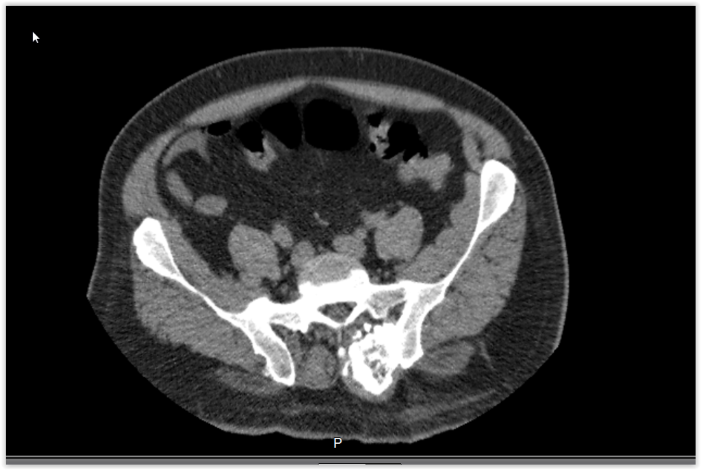 Figura 7: Tomografia com corte ao nível de S1, mostra o aumento da lesão, presa à asa do ilíaco esquerdo, com inúmeras calcificações.