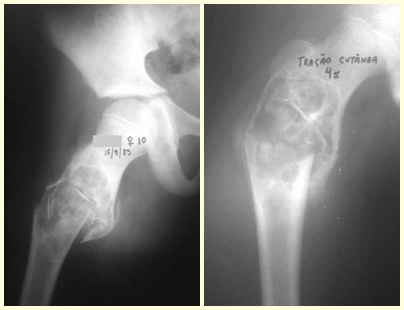 Figura 79 – Diagnóstico do cisto após fratura proximal do fêmur. Fig. 80 – Tratamento incruento, com tração cutânea por seis semanas