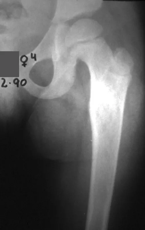 Figura 45 – lesão no fêmur, por displasia fibrosa.