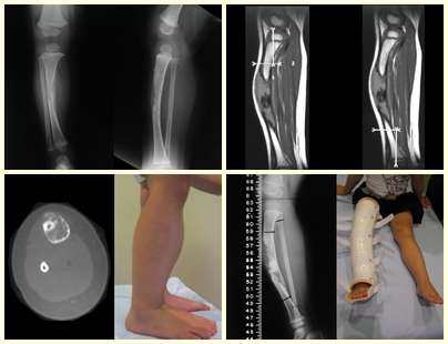 Osteofibrodisplasia com um ano – Planejamento cirúrgico com 3 anos