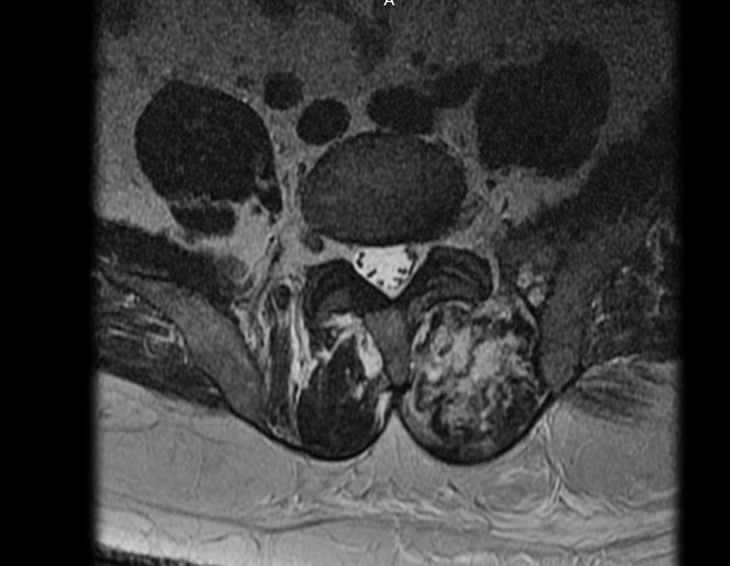 Figura 26: Rm axial T2 , mostrando o acometimento do tumor na região posterior da coluna.