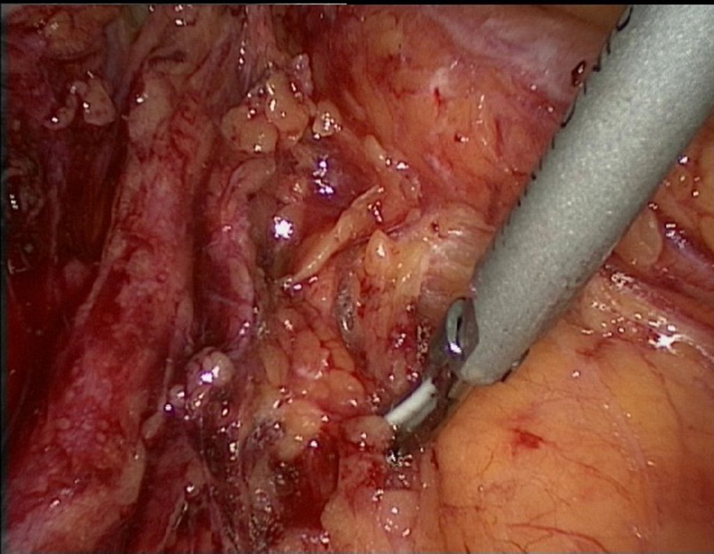 Figura 68: Visão laparoscópica onde o ginecologista acessa o retroperitôneo.