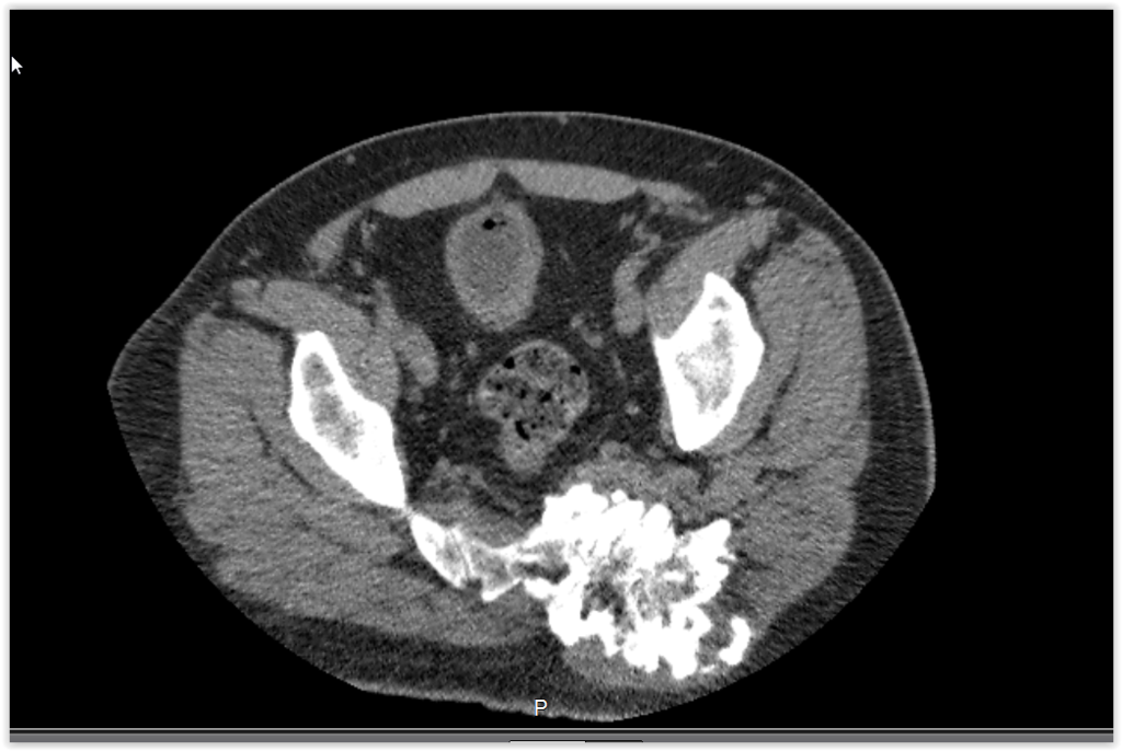 Figura 13: Condrosarcoma comprimindo o nervo ciático.