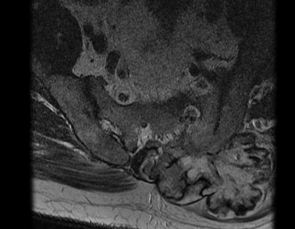 Figura 29: Rm axial T2 ,mostrando a agressividade do tumor na região posterior da coluna.