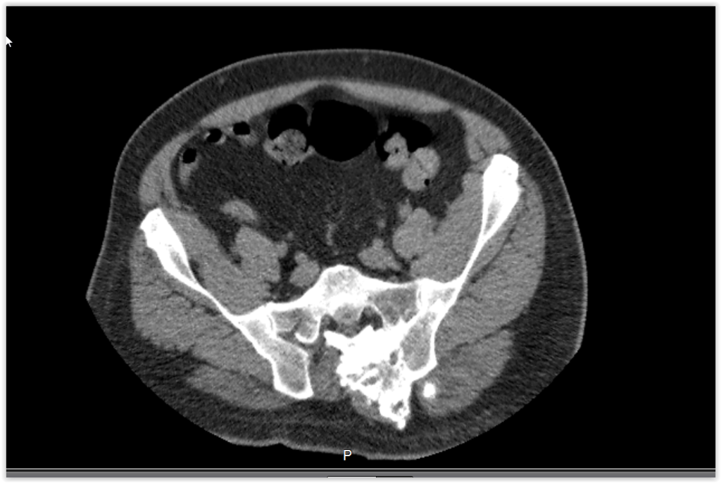 Figura 8: Tomografia com corte mais distal, mostra a lesão afetando a face externa da lâmina e protrusão do tumor em direção à pele.