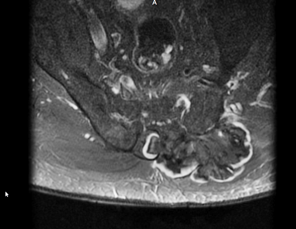 Figura 27: Rm axial T2 ,mostrando o grande volume do tumor na região posterior da coluna.