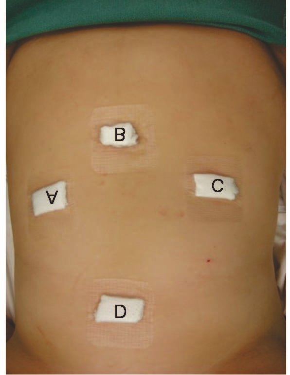 Figure 1 – Dressings corresponding to the trocar positions. A) Right Pararectus (10mm); B) Umbilicus (10mm); C) Left Pararectus (5mm); D) Epigastric (5mm)