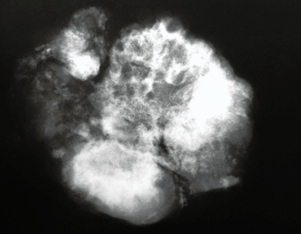 Figura 100: Radiografia da peça cirúrgica realçando a heterogeneidade da lesão.