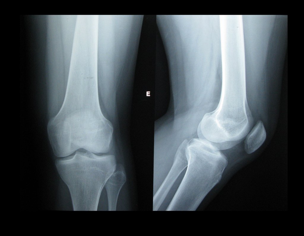 Radiografias do joelho frente e perfil