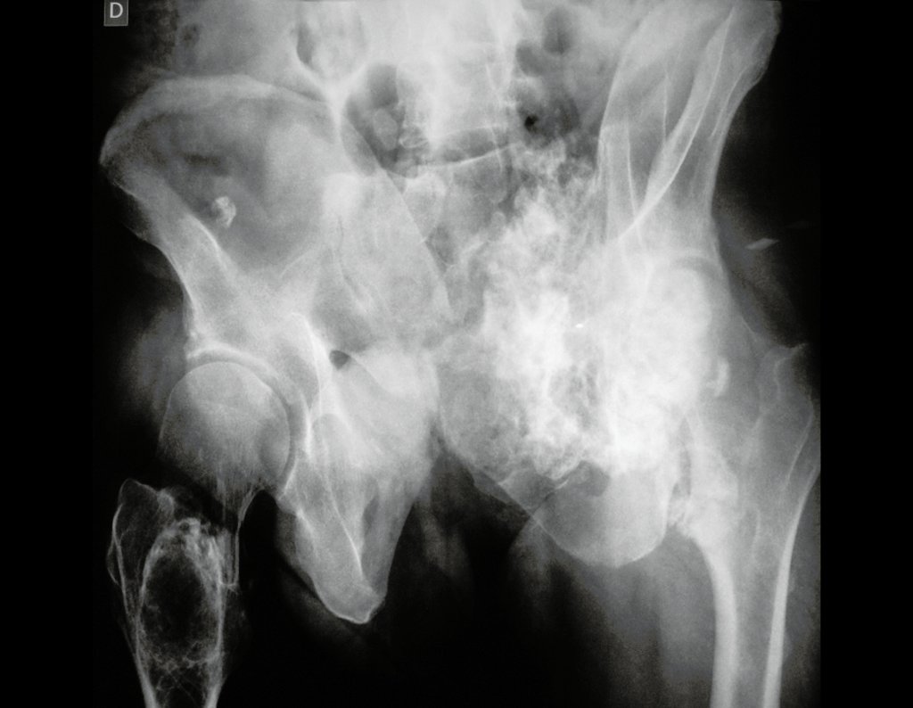 Figura 3: Radiografia obliqua da bacia, que evidencia condrossarcoma envolvendo a articulação sacro ilíaca esquerda, com comprometimento da topografia das raízes nos forames sacrais.