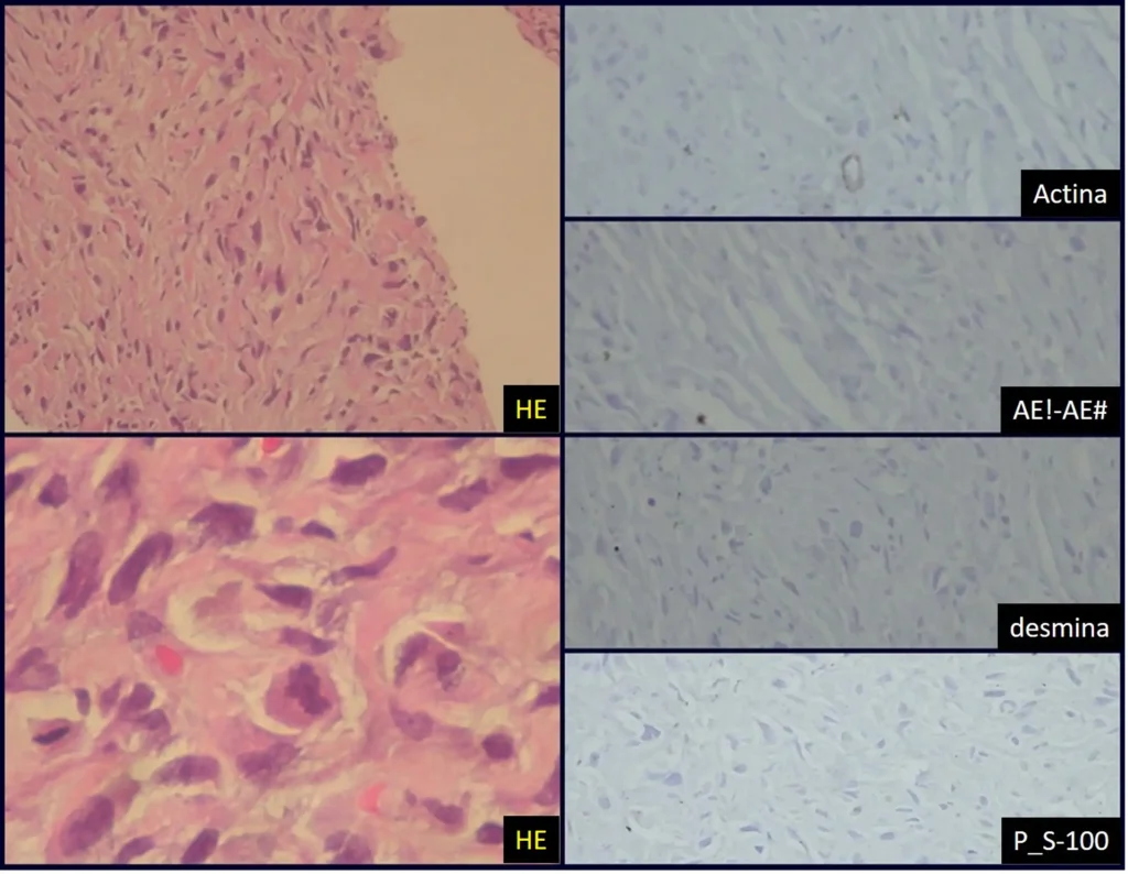 Figura 3: Sarcoma indiferenciado de alto grau. … ?