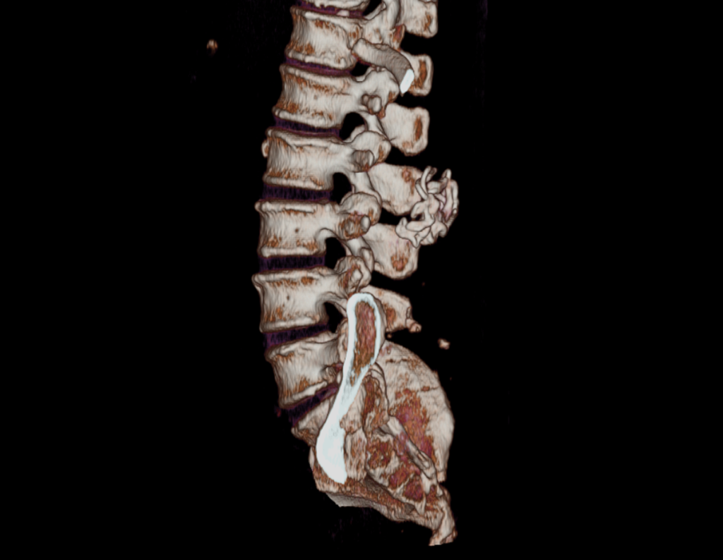 Figura 188: TC 3D vista lateral, evidenciando uma lesão na coluna na região de L4 e L5.