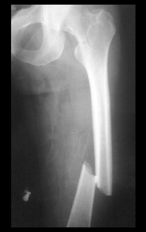 Figura 1: Radiografia do fêmur esquerdo, frente, evidenciando fratura diafisária oblíqua curta.