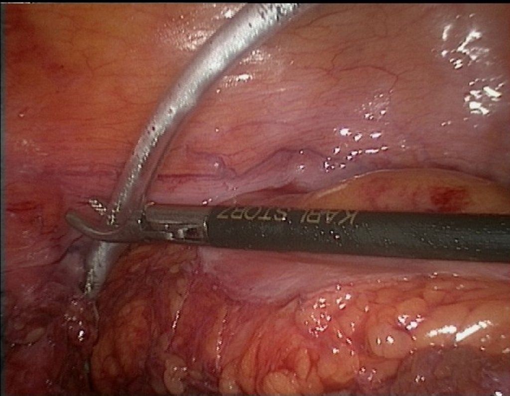 Figura 114: descrição da cirurgia vídeo Laparoscópica.