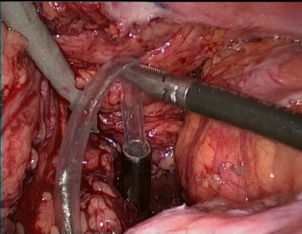 Figura 108: descrição da cirurgia vídeo Laparoscópica.