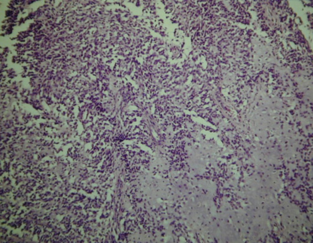 Figura 36: Condrossarcoma mesenquimal.