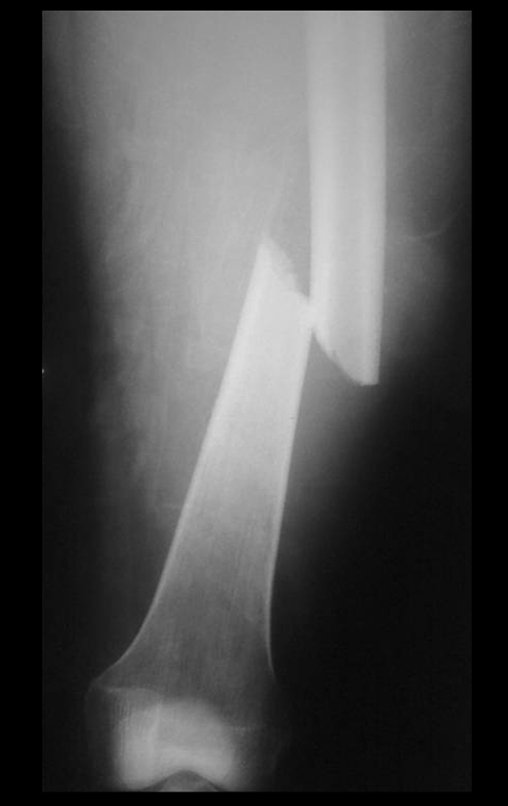 Figura 2: Radiografia frente, com detalhe da fratura em maior aumento e visualização parcial dos côndilos femorais.