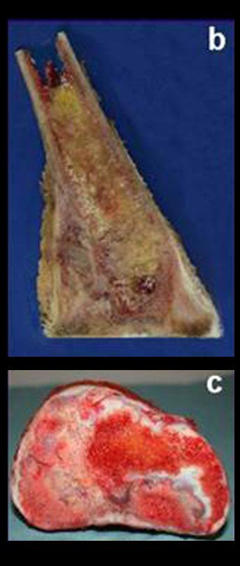 Figura 6: b) ressecção transepifisária; c) corte axial da placa de crescimento, removida com a lesão.