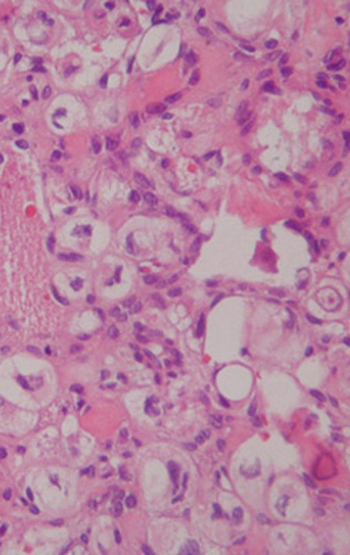 Figura 37: Condrossarcoma de células claras.