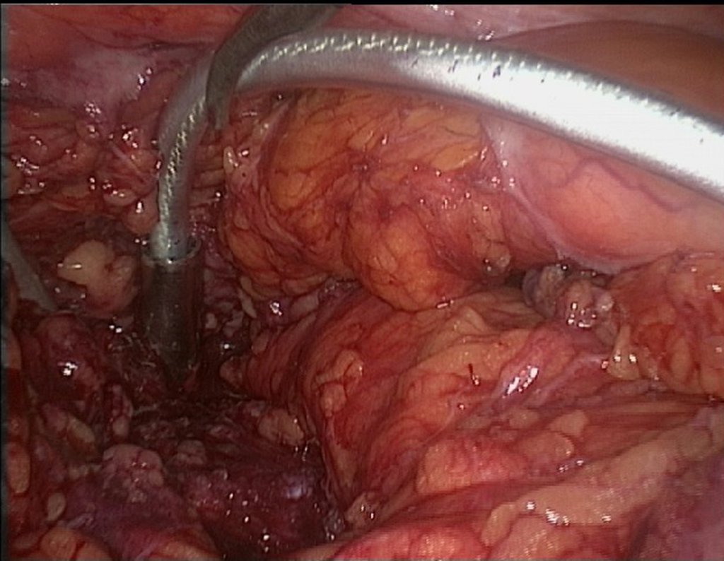 Figura 113: descrição da cirurgia vídeo Laparoscópica.