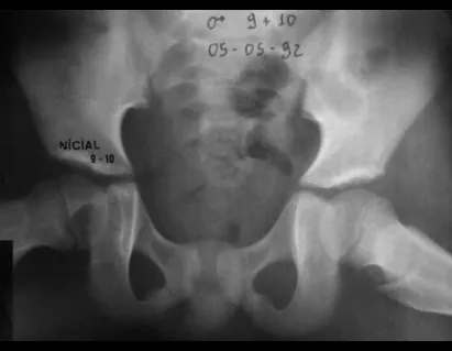 Figura 1 – condroblastoma epifisário do fêmur.