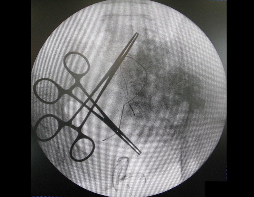 Figura 128: descrição da cirurgia vídeo Laparoscópica.