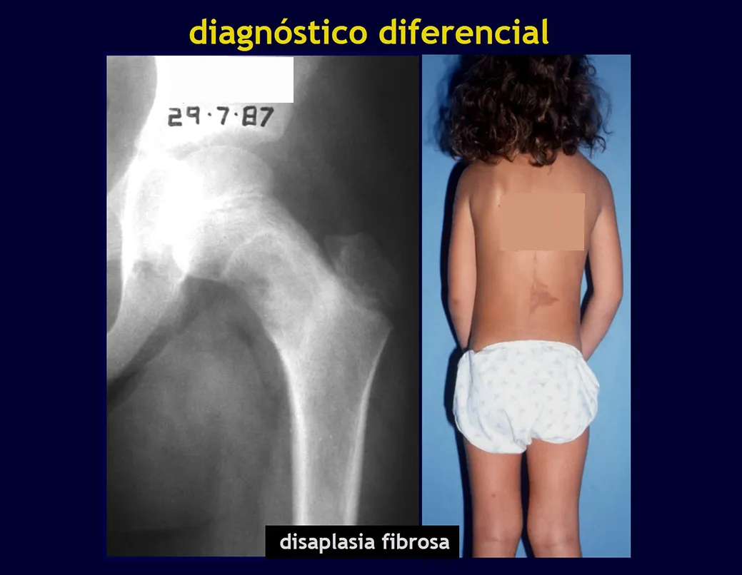 Displasia fibrosa no colo femoral – Mancha café com leite e puberdade precoce (Albright)