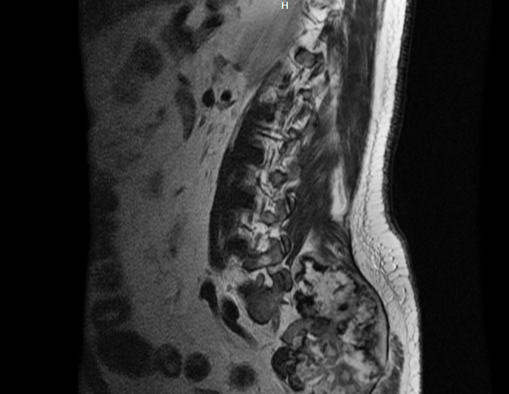 Figura 20: Rm sag T2, lesão heterogênia acomentendo região anterior e posterior do sacro, com focos de calcificação, superficie irregular e espessa capa cartilagionsa.