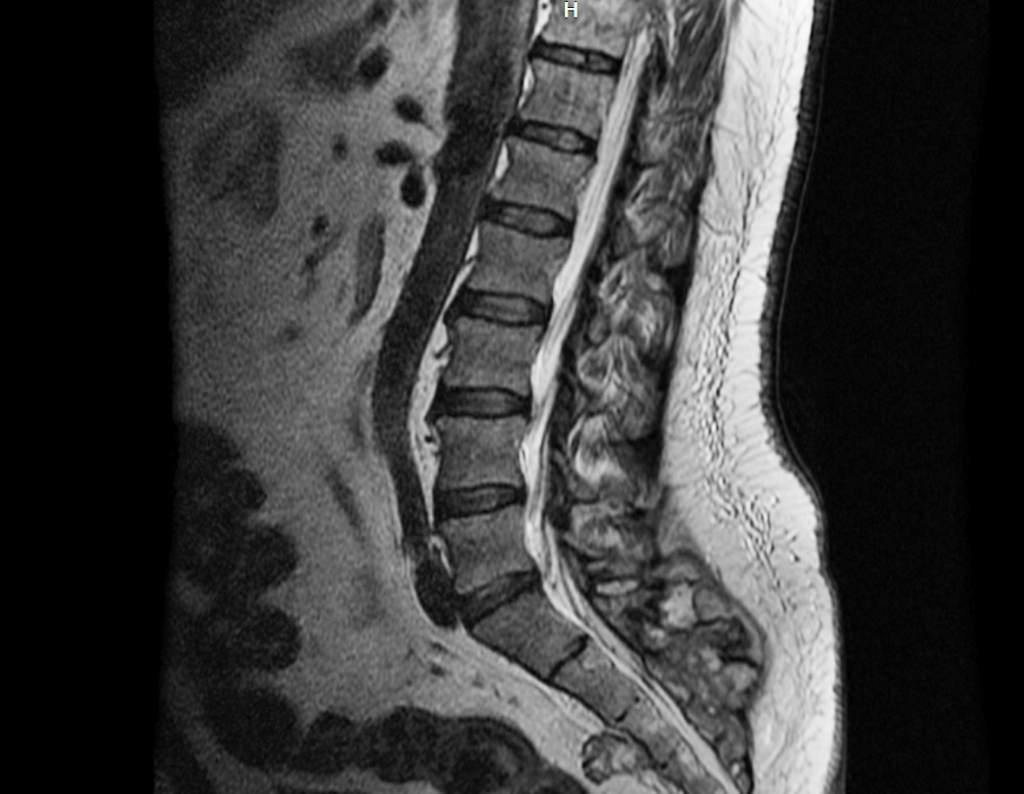 Figura 21: Rm sag T2, lesão heterogênia acomentendo região anterior e posterior do sacro.