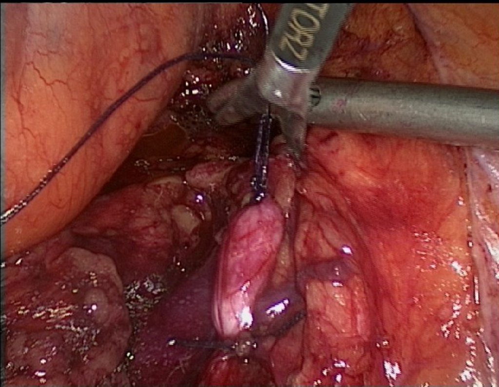 Figura 74: descrição da cirurgia vídeo Laparoscópica.