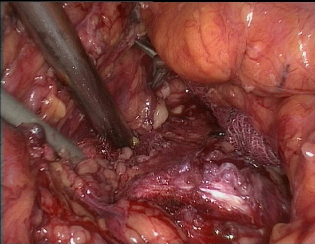 Figura 89: Ao introduzi-lo, o ginecologista irá acompanhar seu movimento intra abdominal pelo vídeo posicionado em outro portal.