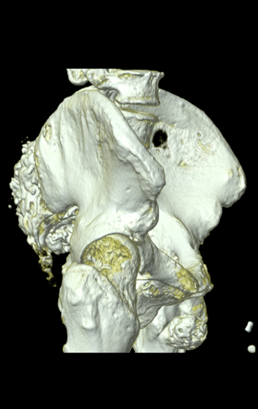 Figura 35: TC em 3D da bacia em perfil do lado direito.