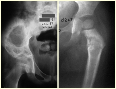 Figura 39 – granuloma eosinófilo do ilíaco – fratura afundamento do acetábulo. Fig. 40 – Fratura incompleta da cortical medial do fêmur, devido à granuloma eosinófilo.