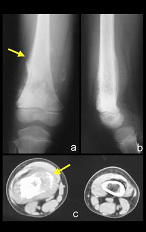 Figura 3: a) osteossarcoma com triângulo de Codman; b) reação periosteal lamelar fina; c) tumor produtor de osso.