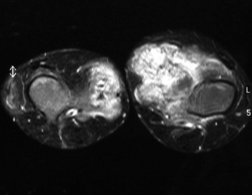 Figura 19: Na ressonância magnética o condrossarcoma periférico secundário à osteocondromatose do fêmur esquerdo apresenta heterogeinicidade e intensa captação de contraste tanto na periferia como no interior da lesão.