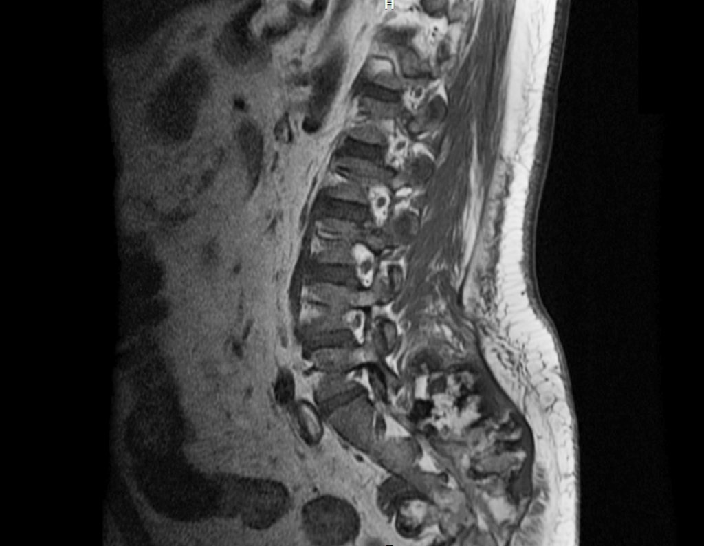 Figura 18: Rm sag T1, lesão heterogênia acomentendo região anterior e posterior do sacro, com focos de calcificação, superficie irregular e espessa capa cartilagionsa.