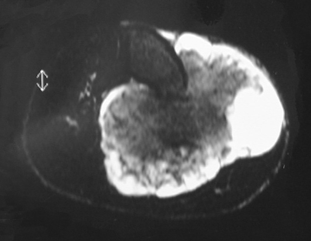 Figura 93: T1 com supressão e contraste caracterizando a agressividade da lesão. Áreas de baixo sinal com focos de calcificação, outras de sinal intermediário e alto sinal. Forte captação de contraste, principalmente na periferia do tumor. Isto é caracteristico neste tipo de condrossarcoma por aumento da capa cartilaginosa.