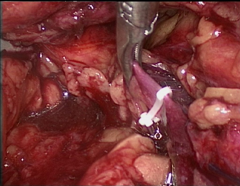 Figura 75: descrição da cirurgia vídeo Laparoscópica.