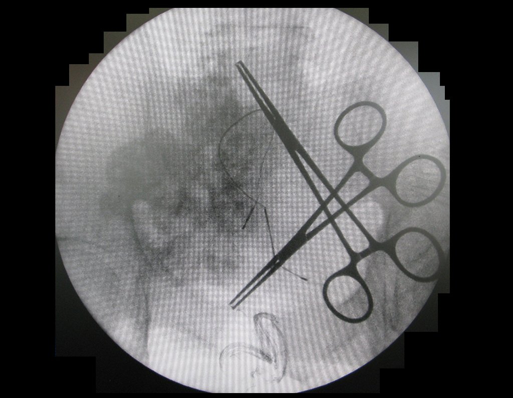 Figura 127: descrição da cirurgia vídeo Laparoscópica.