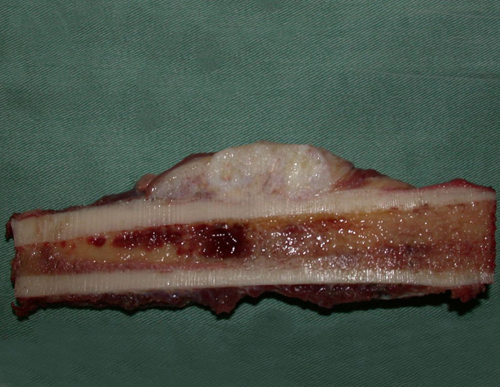 Figura 56: Corte da peça cirúrgica com o condrossarcoma justacortical, apenas na superfície do osso. Observe que a medular óssea e a cortical interna apresentam aspecto normal.