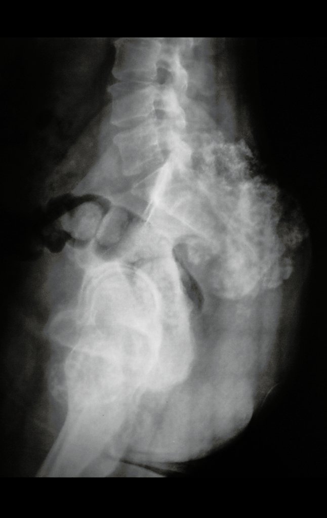 Figura 4: Radiografia em perfil do sacro evidenciando condrossarcoma.