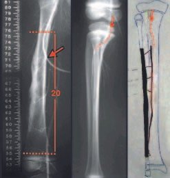 Fig. 1 – Arteriografia do fêmur, mensuração de 20cm de ressecção. Arteriografia da fíbula e esquema do enxerto vascularizado.