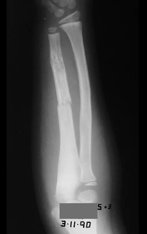 Figura 47 – Fratura da ulna, devido à displasia fibrosa.