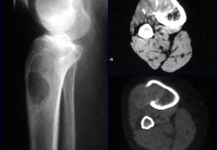 Fibroma Condromixóide: Neoplasia Condromixóide Óssea