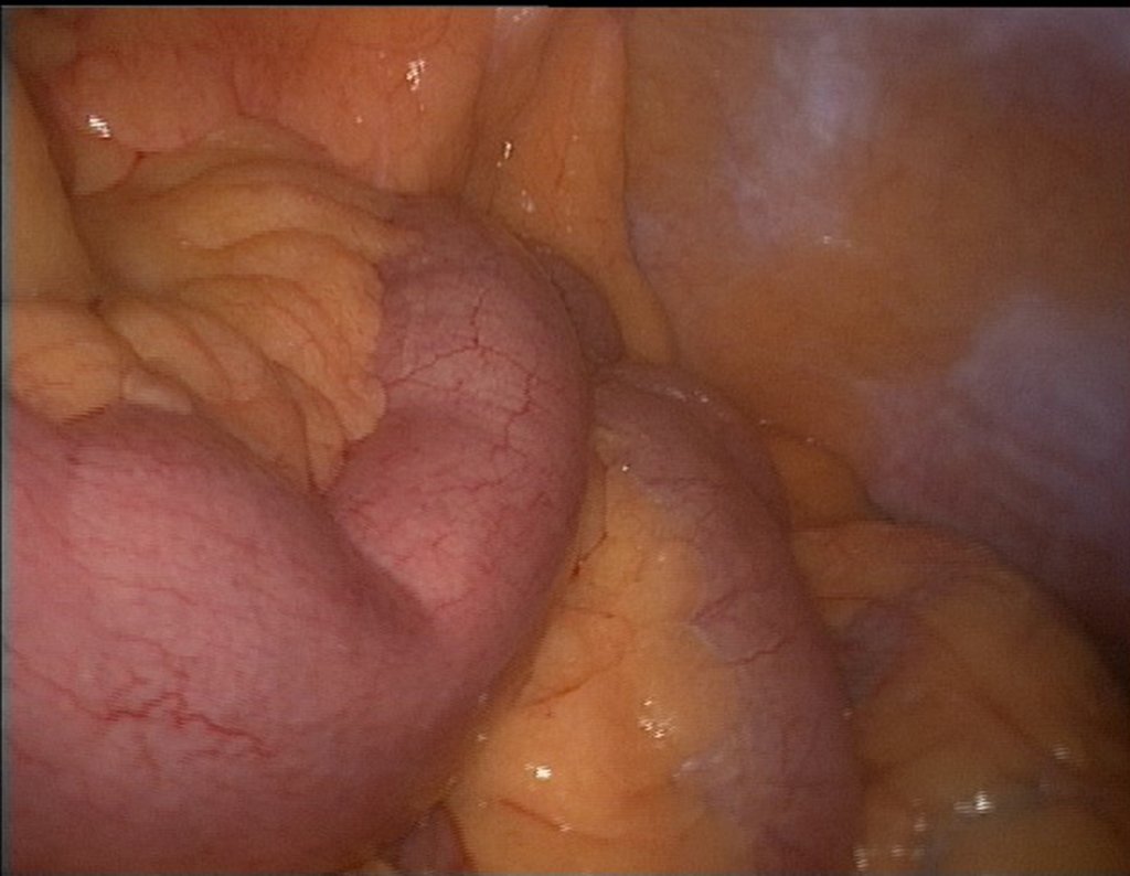 Figura 125: descrição da cirurgia vídeo Laparoscópica.