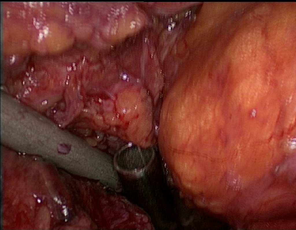 Figura 94: Primeiro cateter de ressecção posicionado corretamente visto pela visão videolaparoscopica da porção anterior do retroperitoneo. Ao lado do cateter encontra-se o sigmóide