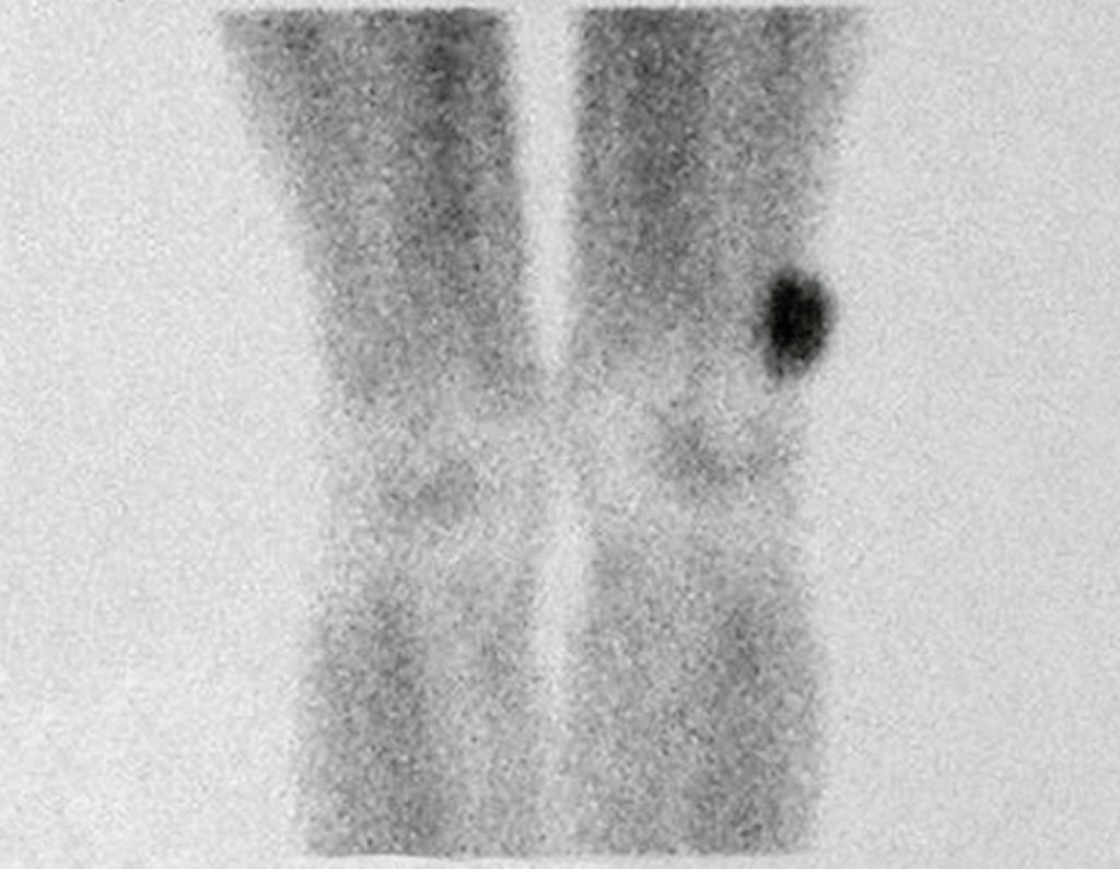 Figura 26: Cintilografia com hipercaptação nos tecidos moles.